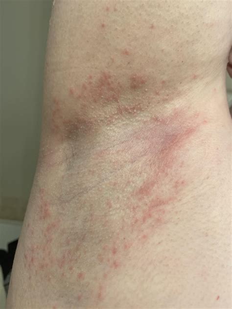 underarm rashes sa kilikili|Armpit Rash: 14 Possible Causes and How to Treat Them .